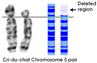 cri du chat chromosome abnormality